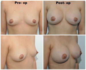 plastic surgery in miami, breast augmentation in miami, transumbilical breast augmentation in miami, breast implant in miami,