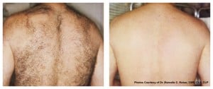 plastic surgery in miami, laser hair removal in miami, 