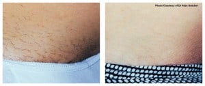 plastic surgery in miami, laser hair removal in miami, 