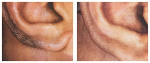 plastic surgery in miami, laser hair removal in miami, 