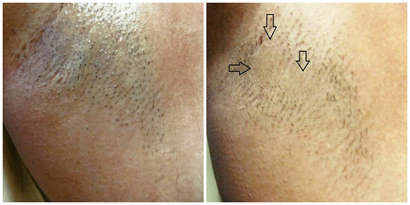 candela laser hair removal