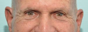 plastic surgery in miami, eyelid surgery in Miami, eye surgery in miami, 