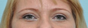 plastic surgery in miami, eyelid surgery in Miami, eye surgery in miami,