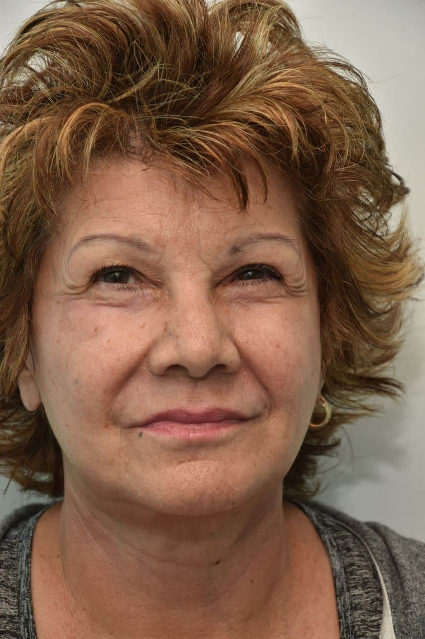 Neck-lift-surgery-2