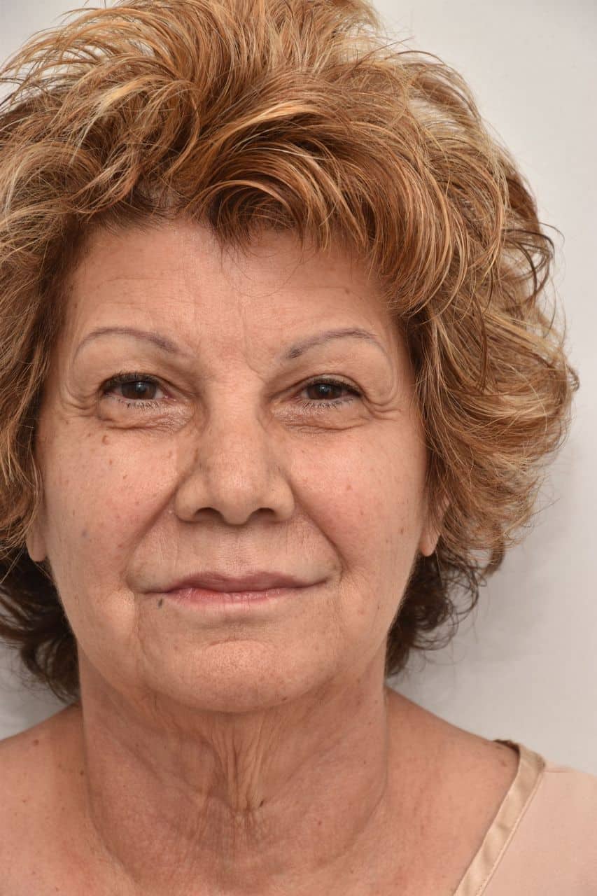 Neck-lift-surgery-4