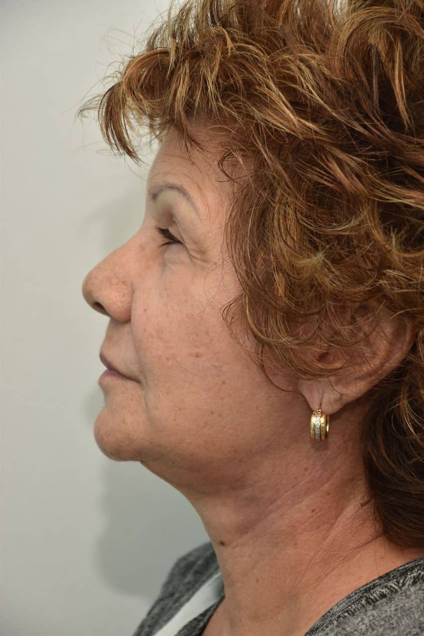 Neck-lift-surgery-5