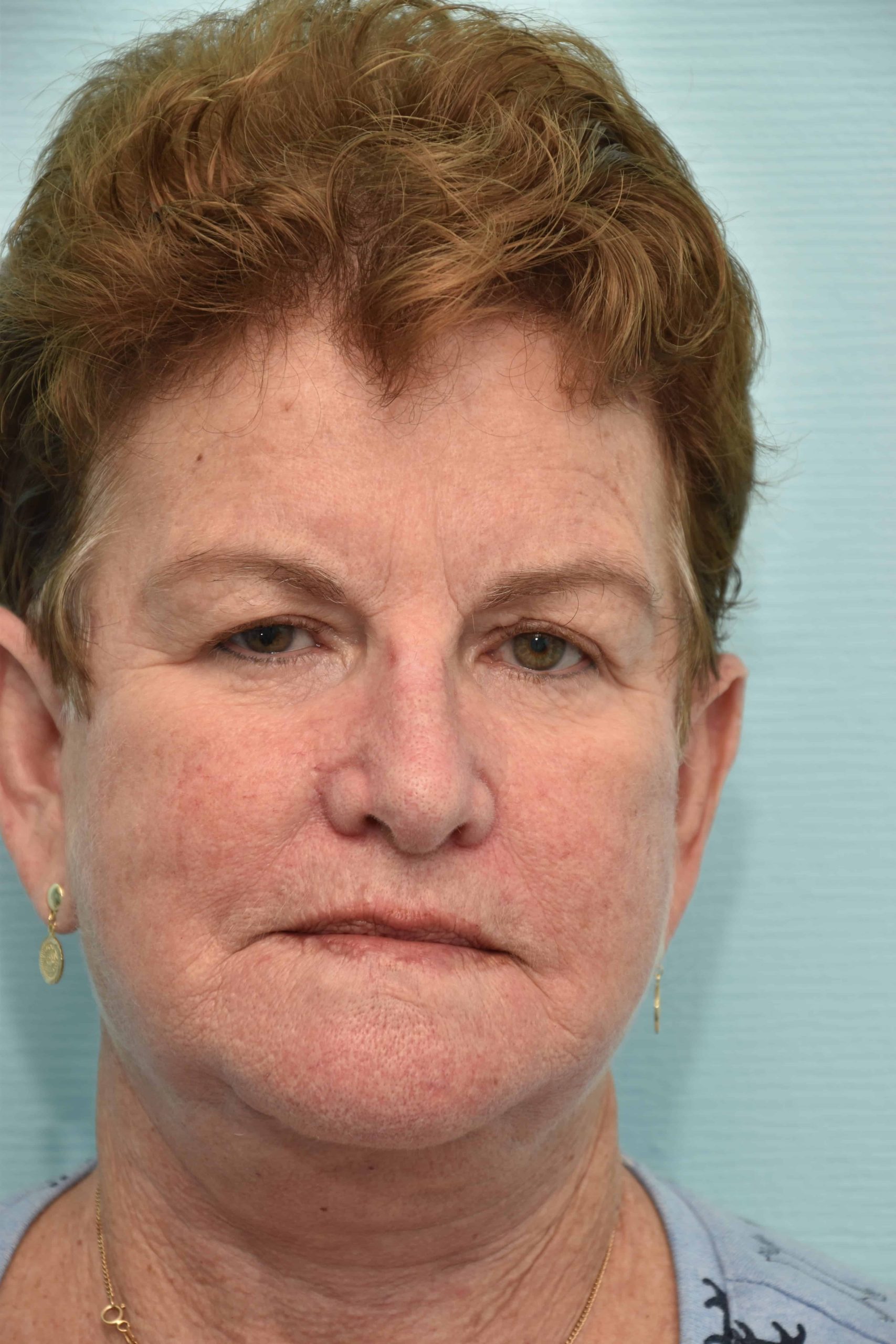 Neck-lift-surgery-8