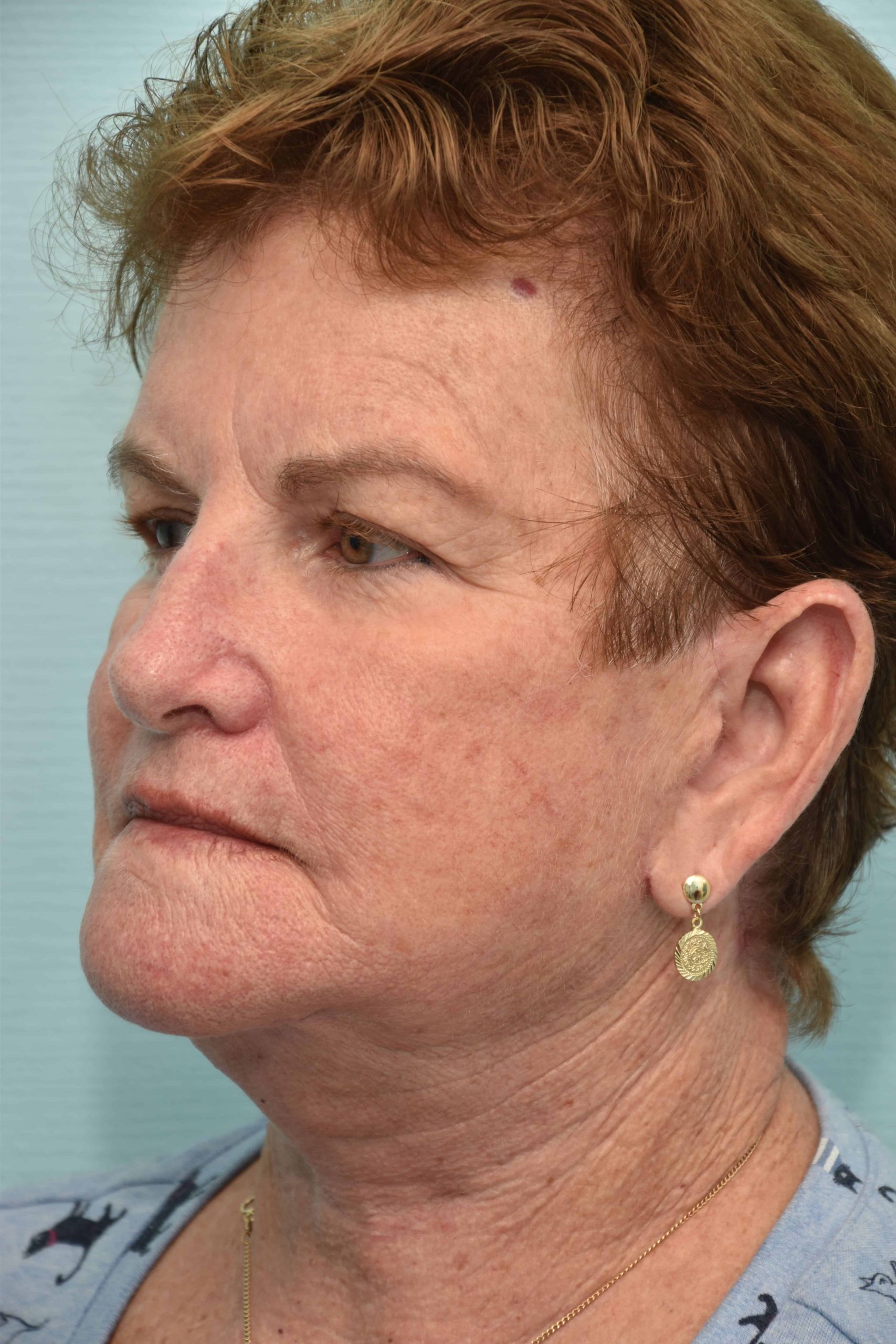 Neck-lift-surgery-9