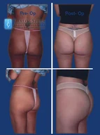 Gluteoplasty gallery photograph 1