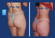 Gluteoplasty gallery photograph 2