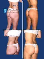 Gluteoplasty gallery photograph 3