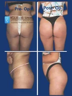Gluteoplasty gallery photograph 4