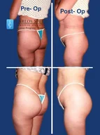 Gluteoplasty gallery photograph 5