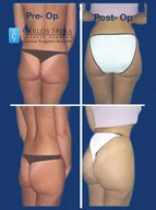 Gluteoplasty gallery photograph 6