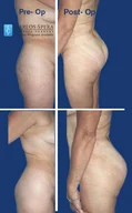 Gluteoplasty gallery photograph 7