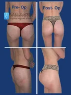 Gluteoplasty gallery photograph 8