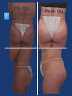 Gluteoplasty gallery photograph 9