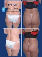 Gluteoplasty gallery photograph 10