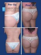 Gluteoplasty gallery photograph 11