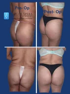 Gluteoplasty gallery photograph 12