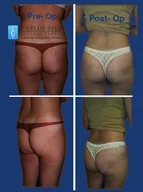 Gluteoplasty gallery photograph 13