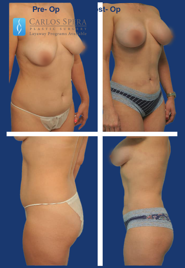 Mommy makeover gallery photograph 1