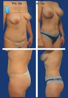 Mommy makeover gallery photograph 1