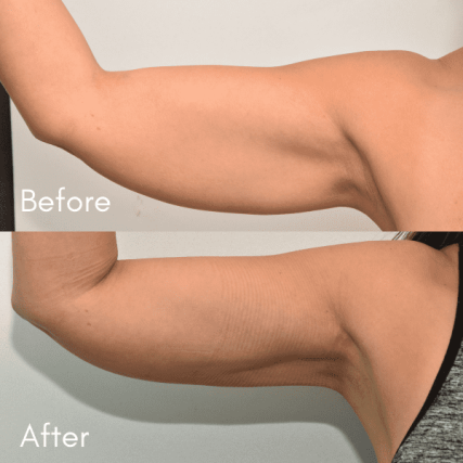Brachioplasty-1