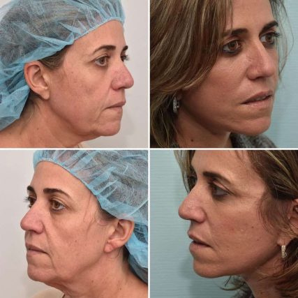 Deep-Plane-Facelift-7
