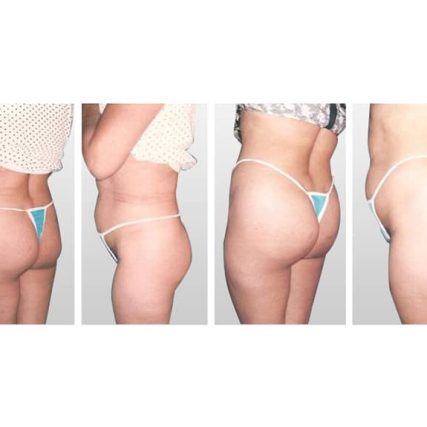 butt-lift-gluteoplasty-miami-carlos-spera-14