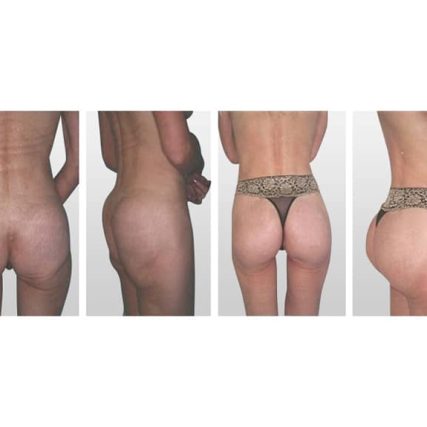 butt-lift-gluteoplasty-miami-carlos-spera-17