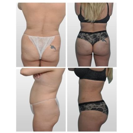 butt-lift-gluteoplasty-miami-carlos-spera-2