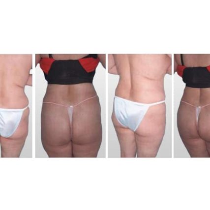 butt-lift-gluteoplasty-miami-carlos-spera-4