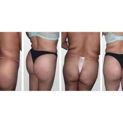 butt-lift-gluteoplasty-miami-carlos-spera-8
