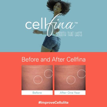 cellfina-cellulite-treatment-miami-carlos-spera-11