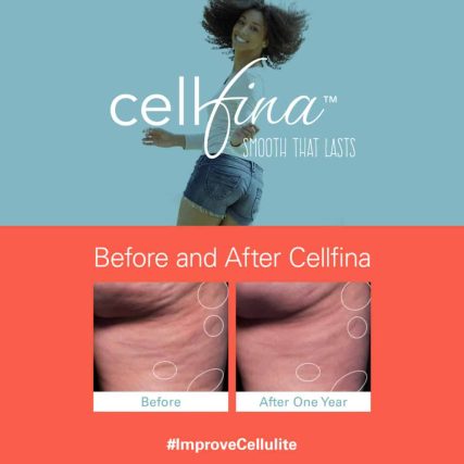 cellfina-cellulite-treatment-miami-carlos-spera-12
