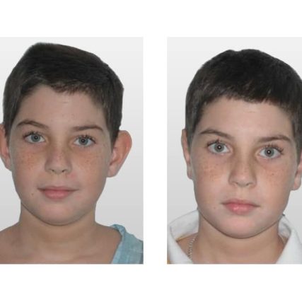 ear-surgery-miami-carlos-spera-2