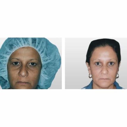 endoscopic-browlift-miami-carlos-spera-3
