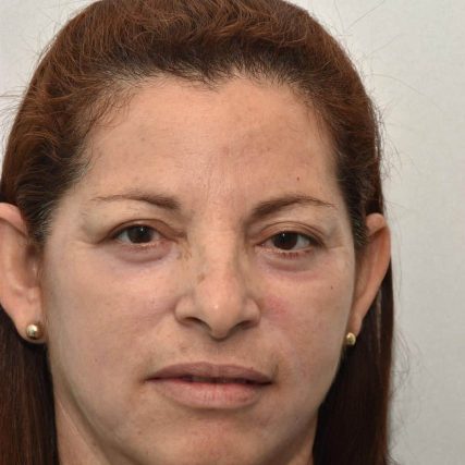 eyelid-surgery-miami-carlos-spera-14