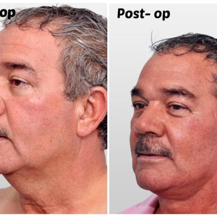 face-lift-rhytidectomy-miami-carlos-spera-11