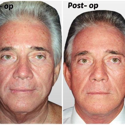face-lift-rhytidectomy-miami-carlos-spera-14