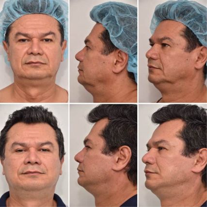 face-lift-rhytidectomy-miami-carlos-spera-19
