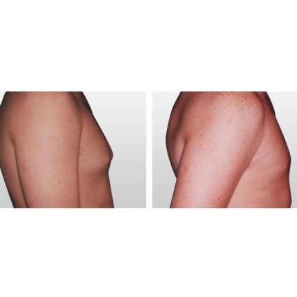 gynecomastia-male-breast-reduction-miami-carlos-spera-2