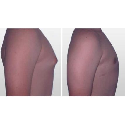 gynecomastia-male-breast-reduction-miami-carlos-spera-3
