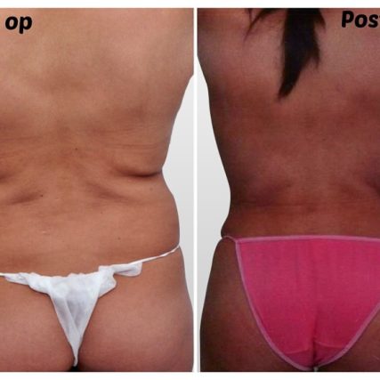liposculpture-miami-carlos-spera-15