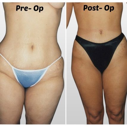 liposculpture-miami-carlos-spera-23