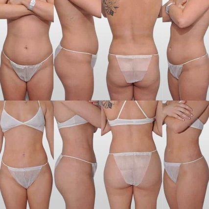 liposculpture-miami-carlos-spera-24