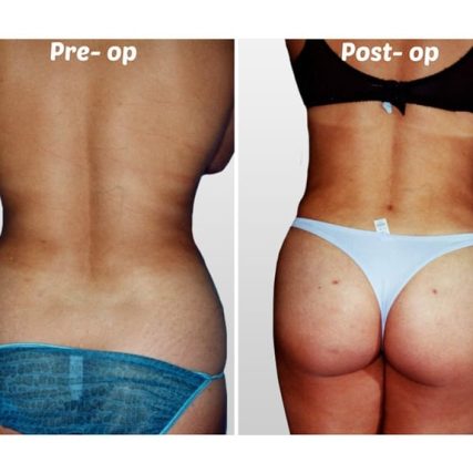 liposculpture-miami-carlos-spera-30