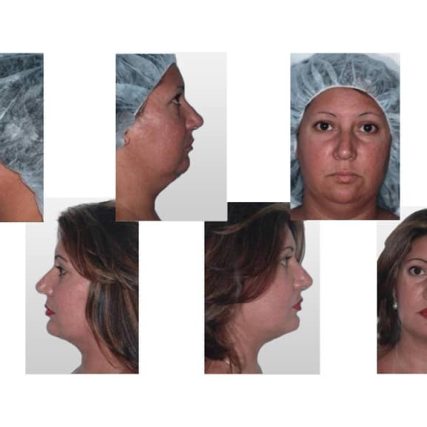 mentoplasty-chin-implants-miami-carlos-spera-5