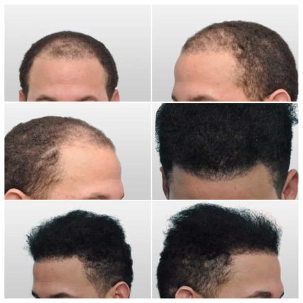 micro-hair-restoration-transplant-miami-carlos-spera-4